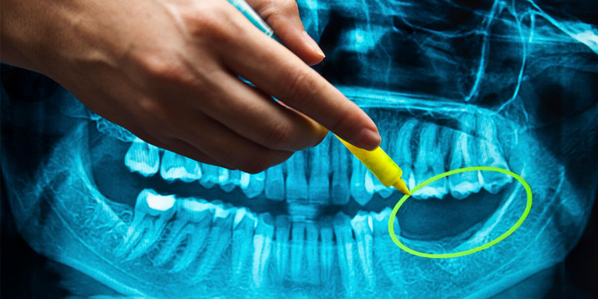 Dental x-ray showing missing teeth and jaw bone resorption